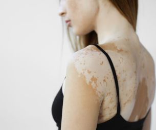 Vitiligo : tout savoir sur cette maladie de la peau